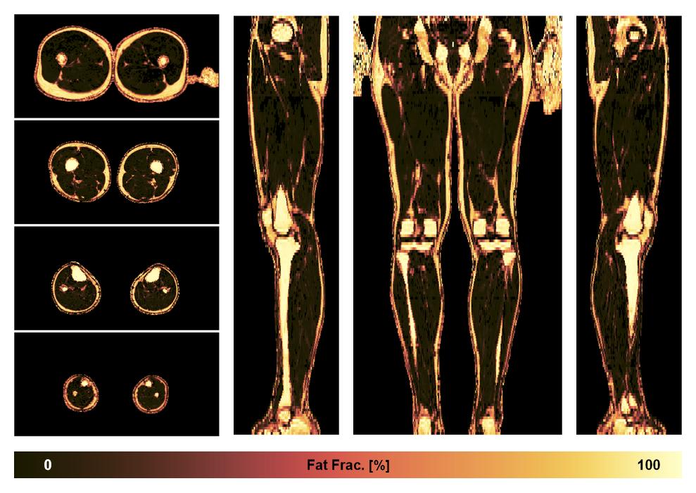 The fat fraction of the lower extremity obtained from the dixon reconstruction for muscle water fat quantification.